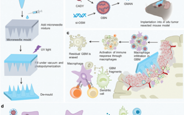 Adv. Mater：植入式微针介导的术后肿瘤病灶根除可减轻胶质母细胞瘤的复发