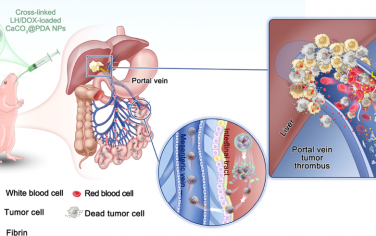 Nano Lett：基于纳米颗粒的口服疗法可有效抑制伴门静脉肿瘤血栓肝细胞癌