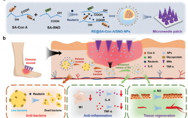 Adv. Mater：负载工程化一氧化氮释放纳米载体的多功能微针贴片用于慢性伤口的靶向协同治疗