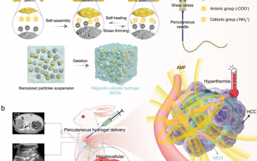 Adv. Mater：通过磁性胶体水凝胶注射剂微创递送经皮消融剂以治疗肝细胞癌